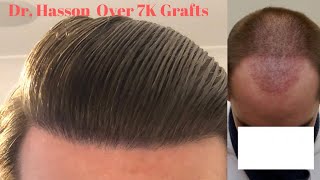 Over 7K Grafts Hair Transplant Results Real Patient Review MUST SEE [upl. by Simara]