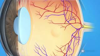 What is dry agerelated macular degeneration AMD [upl. by Lisha598]