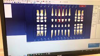 Reset your Dentrix Chart dentrix dental dentalsoftware dentalhygiene dentalhygienist [upl. by Marion]