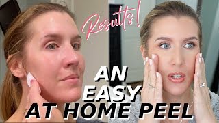 At Home Glycolic Acid Peel THAT WORKS  Over 40 Skincare [upl. by Cleodel]