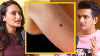 Can Moles Become Cancerous  Top Skin Doctor Explains [upl. by Alenas]