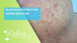 Blackheads Extraction Hidden Gem Paris [upl. by Nomit]