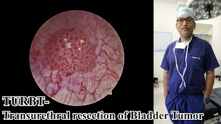 TURBTTransurethral resection of Bladder TumorDr Brojen Barman [upl. by Naasar]