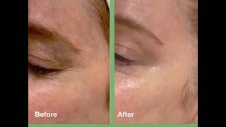 Under Eye and Temporal Vein Laser Treatment and Removal [upl. by Hamfurd]