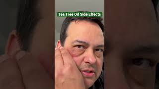 Tea Tree Oil Side Effects short [upl. by Deering866]