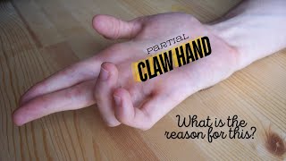 What is the reason for partial claw hand or ulnar claw hand ulnarnerve clinicalanatomy [upl. by Irish]