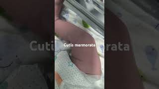 Cutis marmoratanewborn paeds clinical [upl. by Kuska]