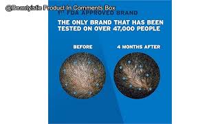 Mens Rogaine 5 Minoxidil Foam Review Is It the Solution for Hair Regrowth You Need [upl. by Purdy]