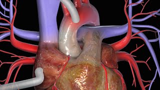 KoronararterienBypass CABG [upl. by Eneryt26]