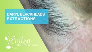 Extractions of Blackheads and Cyst on Daryl [upl. by Ainiger715]