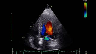 ECOCARDIOGRAMA DOPPLER COLOR [upl. by Nnainot474]