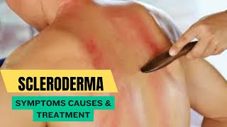 Scleroderma Symptoms Causes amp Treatment [upl. by Koran]