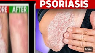 ECZEMA PSORIASIS KA TREATMENT [upl. by Ahsatak]