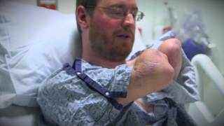 Will Lautzenheiser Bilateral Arm Transplant Recipient Video [upl. by Niala]