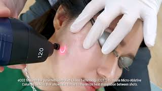 Co2 Fractional Laser Treatment [upl. by Akiehsal]