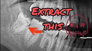 Extract this Tooth Surgical Extraction [upl. by Rehpatsirhc]