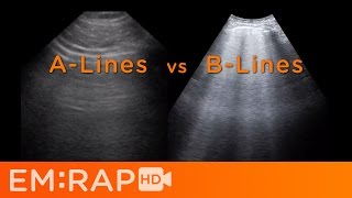 Ultrasound of Pulmonary Edema [upl. by Eirallih]