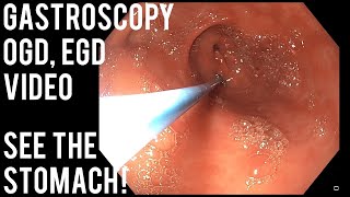 Gastroscopy  OGD  See inside the stomach [upl. by Hitchcock]