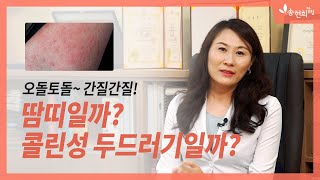 여름철 가려움 땀띠 콜린성 두르러기 콜린성두드러기의 다양한 형태 [upl. by Aij471]