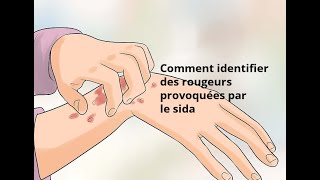 Comment identifier des rougeurs provoquées par le sida [upl. by Tem]