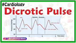 Dicrotic pulse  Internal medicine  Usmle Cardiology [upl. by Enois711]