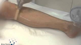 MeDioStar NeXT  Training video for hair removal legs from Asclepion [upl. by Trebliw193]