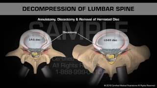 Decompression of Lumbar Spine [upl. by Stillman]