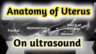 Sonographic Anatomy of UterusGyneacological ultrasound [upl. by Resiak]