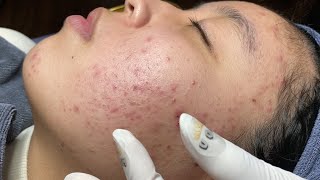 ACNE TREATMENT VU QUYNH MI Acne On Teens Chin 2024 [upl. by Ling960]