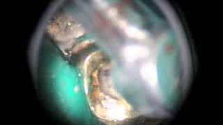 Endodontic Access Maxillary First Molar [upl. by Abramson]