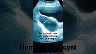 Ovarian Hemorrhagic cyst and endometrioma cyst in patient with irregular bleedingperiod [upl. by Jonme]