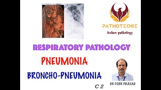 Pneumonia  Bronchopneumonia [upl. by Eenerb]