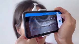 Check meibomian gland with smartphone meibographer MeiboVue [upl. by Annawik]