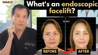 Whats an Endoscopic Facelift Wave Plastic Surgery [upl. by Idette340]