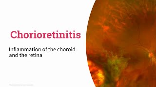 Chorioretinitis [upl. by Anaele]