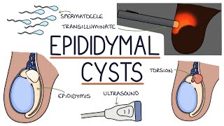 Understanding Epididymal Cysts [upl. by Kilian]