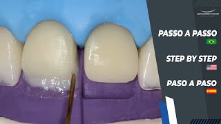 Diastema and Incisal Increase I Diastema y Alargamiento Incisal I Diastema e Aumento Incisal [upl. by Ahsad]