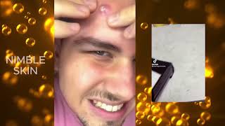 30 minutes of Pimple Popping Compilation [upl. by Clerk]