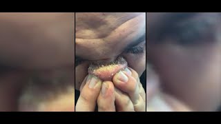 DIY Blackhead Removal Goes Viral [upl. by Ttevy]