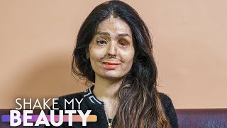 I Survived An Acid Attack  SHAKE MY BEAUTY [upl. by Eisor]