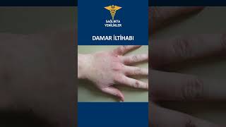 DAMAR İLTİHABI [upl. by Noek]