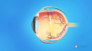 What is scleral buckle surgery [upl. by Nilad]