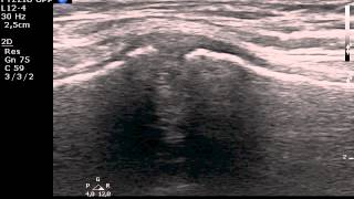 Manubriosternal joint MSKUS ultrasound [upl. by Barthel]