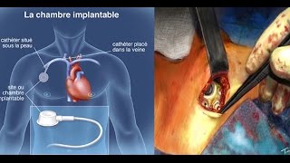 Chambre implantable de perfusion port a cath mise en place chirurgicale animation [upl. by Htenywg]