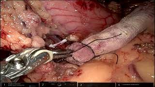 Robotic Harvesting of Pedicled Omental Flap [upl. by Wolf]