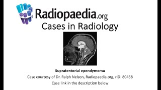 Supratentorial ependymoma Radiopaediaorg Cases in Radiology [upl. by Kidder175]