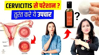 Ayurvedic Treatment For Cervicitis  CERVICITIS TREATMENT  बच्चेदानी के मुख की सूजन  कारण और इलाज [upl. by Baynebridge]