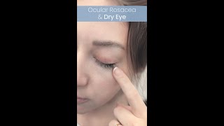 Ocular Rosacea amp Dry Eye [upl. by Ratib]