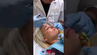 Lip Filler Procedure at EDEN AESTHETICS Clinic Dubai  Enhance Your Lips for a Fuller Natural Look [upl. by Loy]