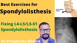 Best Exercises For SpondylolisthesisTop way to Correct AnterolisthesisL4L5S1 [upl. by Ayotas254]